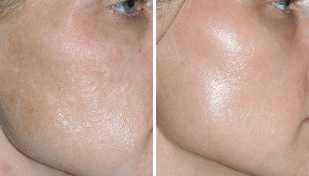 Morpheus8 for uneven skin texture Los Angeles