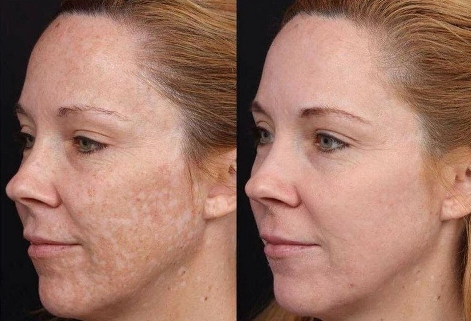 PRX peel for pigmentation treatment before-after Los Angeles