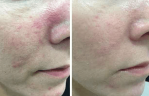 lumecca-ipl-for-rosacea-Los Angeles