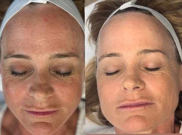 dry skin-treatment-with-Diamond-Glow-Facial-Los-Angeles